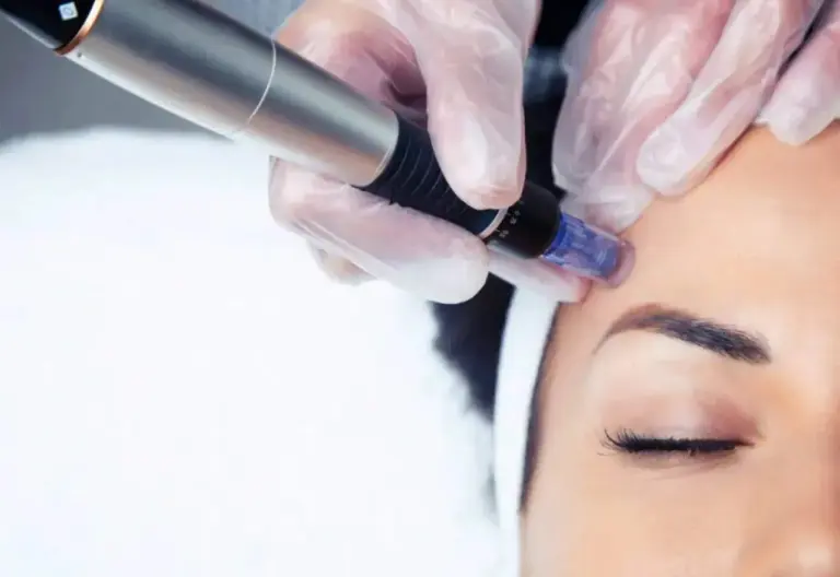 Close-up van een microneedling-behandeling bij Nash Glow
