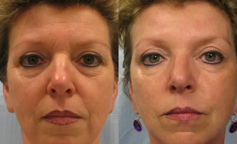 Resultaat van een PRX-T33 peel, voor en na